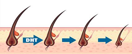 How to Promote Hairgrowth and Prevent/Reverse Hairloss and Thinning hair using DHT Blockers