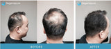 DR +NT Regenepure Shower Treatment Combo